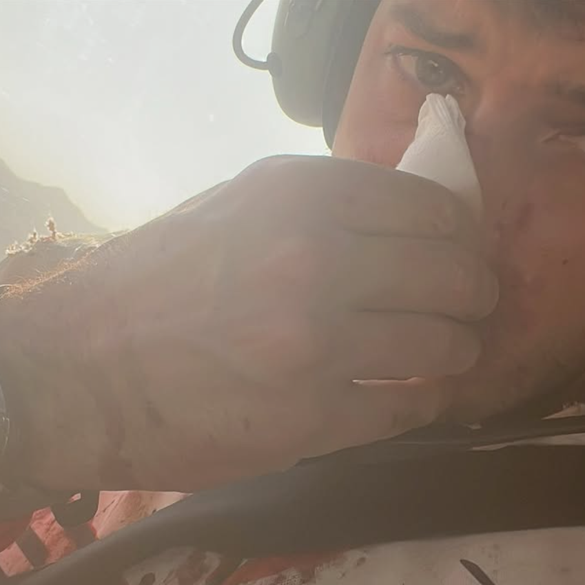 James Hillier with a broken nose on the 2025 Dakar Rally. Credit: Instagram/James Hillier.